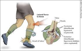 ankle syndesmosis